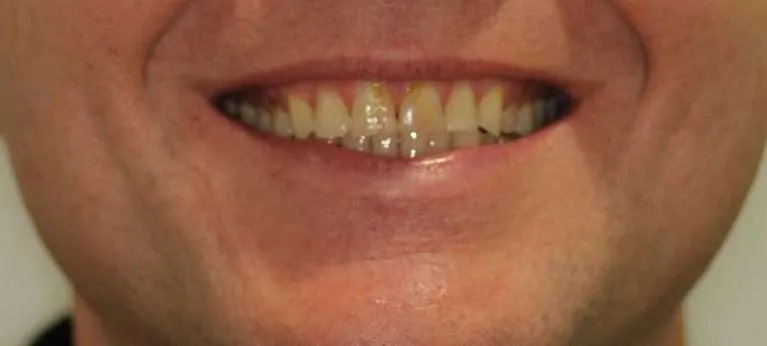 Before porcelain crowns and veneers: chipped and worn teeth