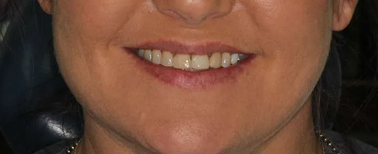 Before porcelain crowns: stained and worn teeth