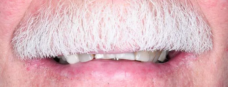 Before porcelain crowns treatment: patient's teeth showing wear and discoloration
