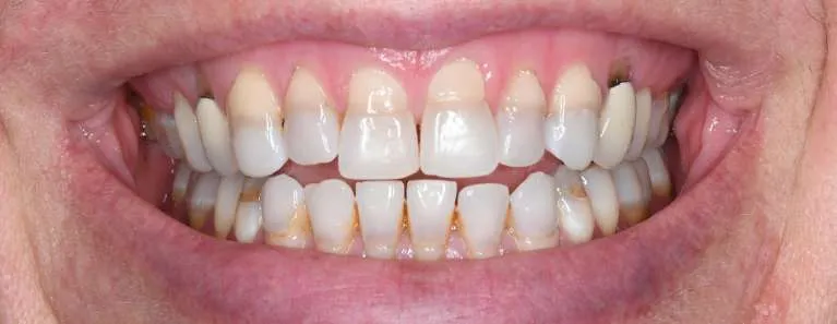 Before porcelain veneers: gaps and misalignment