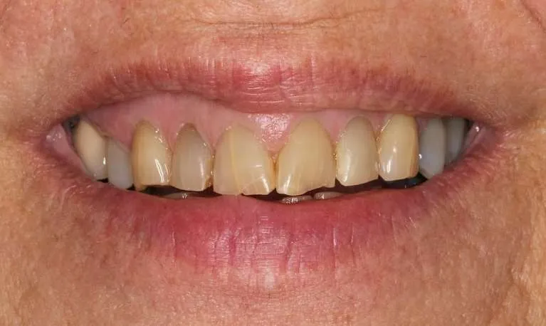 Before eight porcelain crowns: broken, discolored, and worn teeth