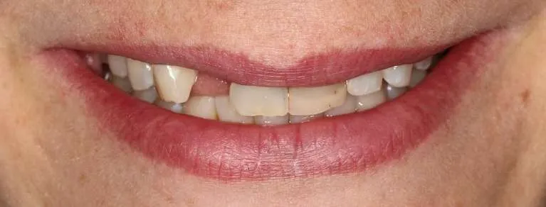Before dental implant and crowns: missing and broken teeth