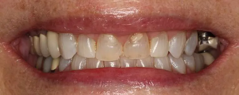Before teeth whitening, crowns, and implants: stained teeth with gaps