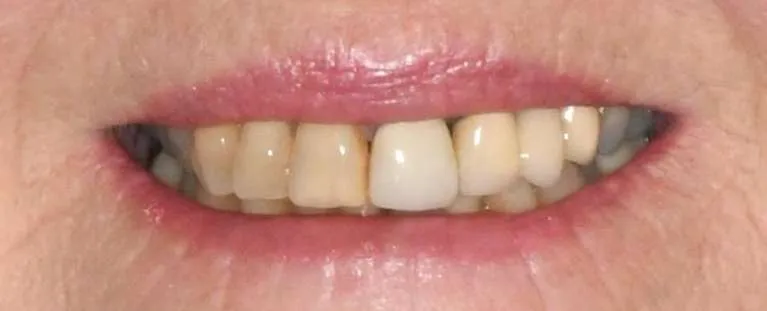 Before teeth whitening, crowns, and bridge: discolored teeth with gaps