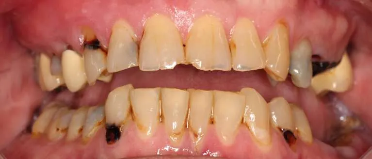 Before comprehensive smile transformation: stained teeth with gaps and missing teeth