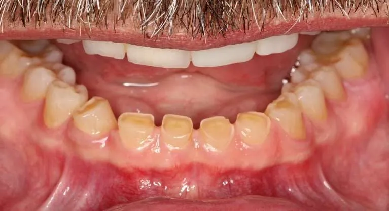 Before porcelain crowns on lower teeth: worn through to dentin