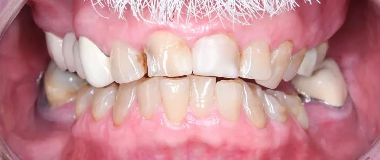 Before porcelain crowns, second angle