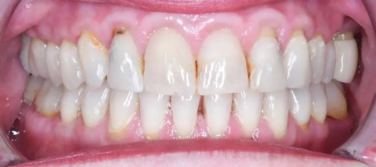 Before porcelain crowns, second view