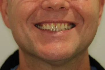 Close-up cosmetic dentistry result, a real smile from our practice